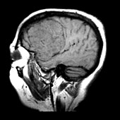 MRI Large Pterional Meningioma