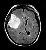 MRI Large Pterional Meningioma
