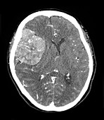 CT Large Pterional Meningioma