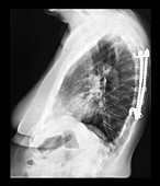 Thoracic Harrington Rods on Chest X-Ray