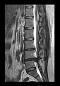 MRI Large L4 5 Disc Herniation and Spinal Stenosis
