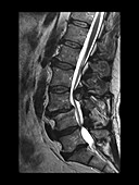 MRI Lumbar Degenerative Spinal Stenosis