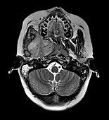 Rhabdomyosarcoma Infratemporal Fossa