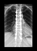 Frontal X-ray Thoracic Spinal Instrumentation