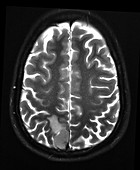 Mesial Parietal Meningioma MRI