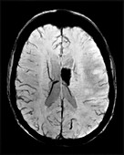Haemorrhagic MCA Infarct MRI
