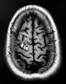 Cavernous Malformation Frontal Lobe MRI