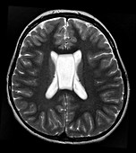 MRI Cavum Septum Pellucidum et Vergae