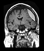 MRI Subdural Hematoma