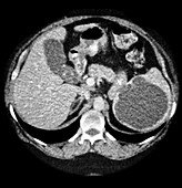 CT of Splenic Cyst