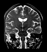 MRI Mastoiditis