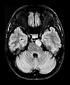 Pre-pontine Meningioma MRI