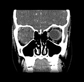 Orbital Pseudotumor on CT