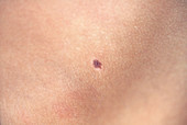 Halo nevus