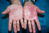 Psoriasis