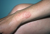 Poison Oak Rash