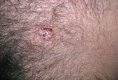 Basal Cell Carcinoma