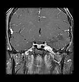 MRI Neurofibromatosis Type 2 (MISME) 3