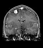 MRI of Arterial Venous Fistulas 4