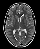 MRI of Arterial Venous Fistulas 1