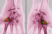 Kienbock's Disease, X-ray