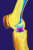 Knee Osteoarthritis, X-ray