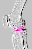 Knee Osteoarthritis, X-ray