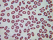 Hereditary elliptocytosis, LM