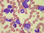 Chronic Mylegenous Leukaemia, LM