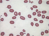Teardrop red blood cells, LM