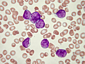 Blood cancer, Acute lymphocytic leukaemia, LM