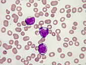 Blood cancer, Acute lymphocytic leukaemia, LM