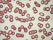 Rouleaux red blood cells, LM