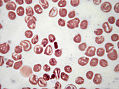 Homozygous haemoglobin E, LM