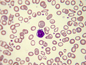 Microcytic hypochromic anaemia, LM