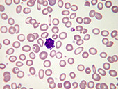 Microcytic hypochromic anaemia, LM