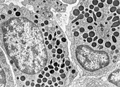 Eosinophilic Myelocytes, TEM