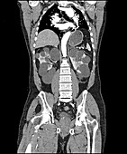 Polycystic Kidney Disease on CT