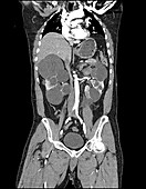 Polycystic Kidney Disease on CT