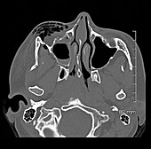 CT of Zygomaticomaxillary Complex Fracture