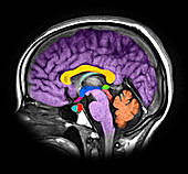 Enhanced Normal Sagittal MRI Brain
