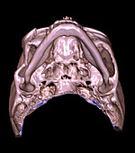 Enhanced 3D CT of Zygomaticomaxillary Complex Fracture