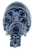 Enhanced 3D CT of Lefort Facial Fractures