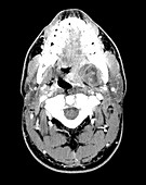 CT of Odontogenic Abscess Masticator Space