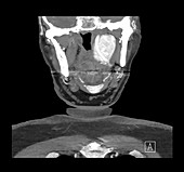 CT of Large Glomus tumour of Neck