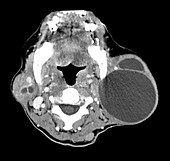 Benign Lymphoepithelial Lesions in HIV on CT