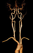 3D CTA of Aortic Arch and Neck Vessels