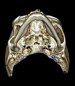 3D CT of Zygomaticomaxillary Complex Fracture