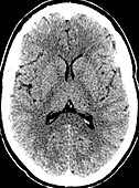 Normal CT Head