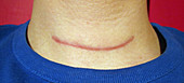 Thyroidectomy Scar